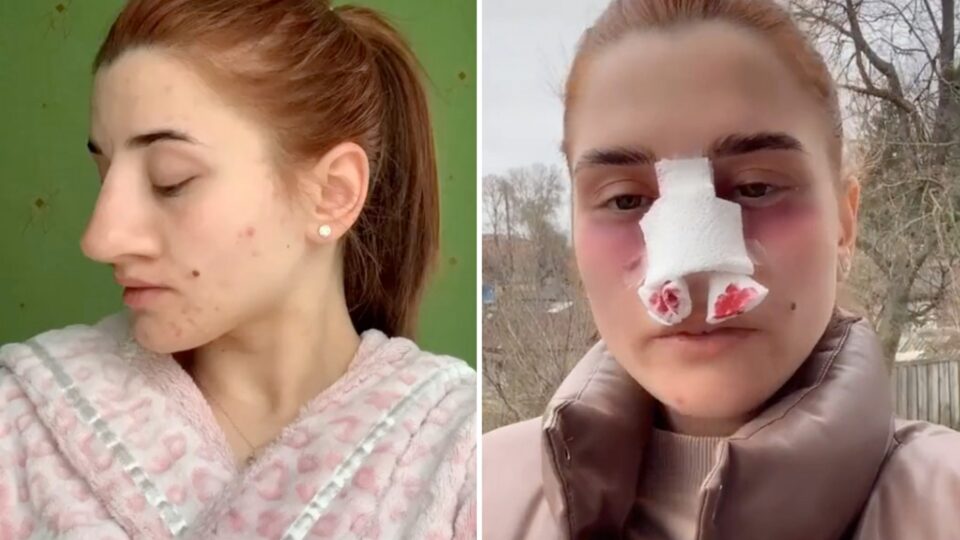 Олга (22) го оперираше ОГРОМНИОТ нос: Кога ќе видите како сега изгледа, ќе останете без зборови (ФОТО)