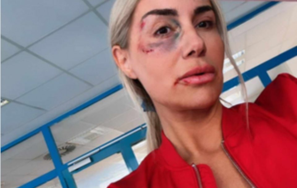 Селма Бајрами објави вознемирувачка фотографија: Дали пејачката е претепана?
