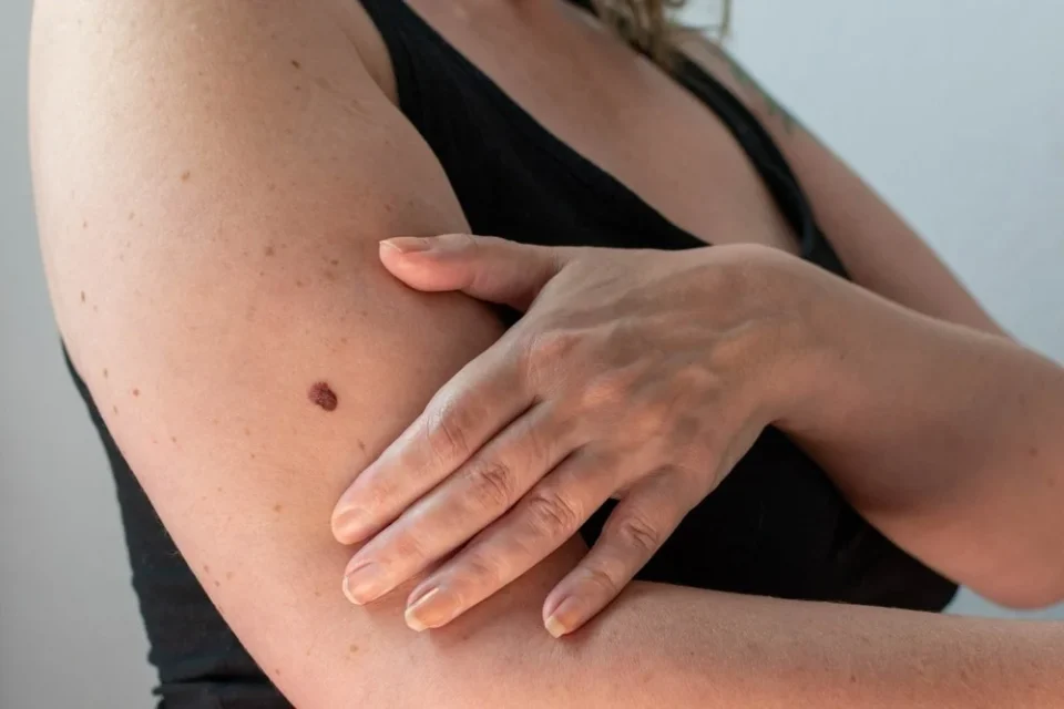 ФОТО: Жена сподели фотографија од „обична“ бенка која всушност е најсмртоносен рак на кожата