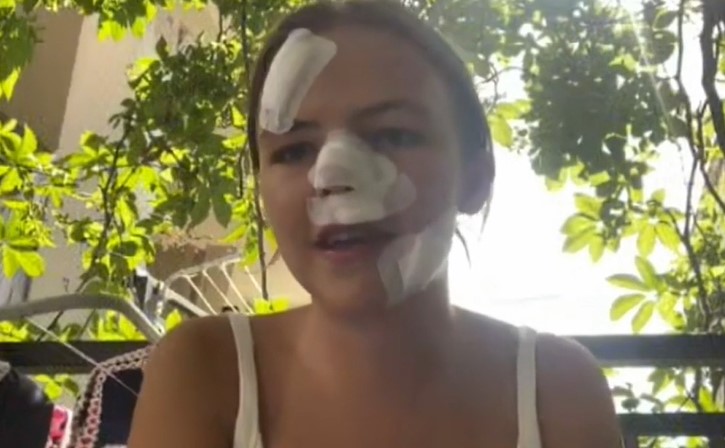 ФОТО: 18 годишно девојче доживеа голгота на одмор во Хрватска – „Завршив со 15 конци на лицето“